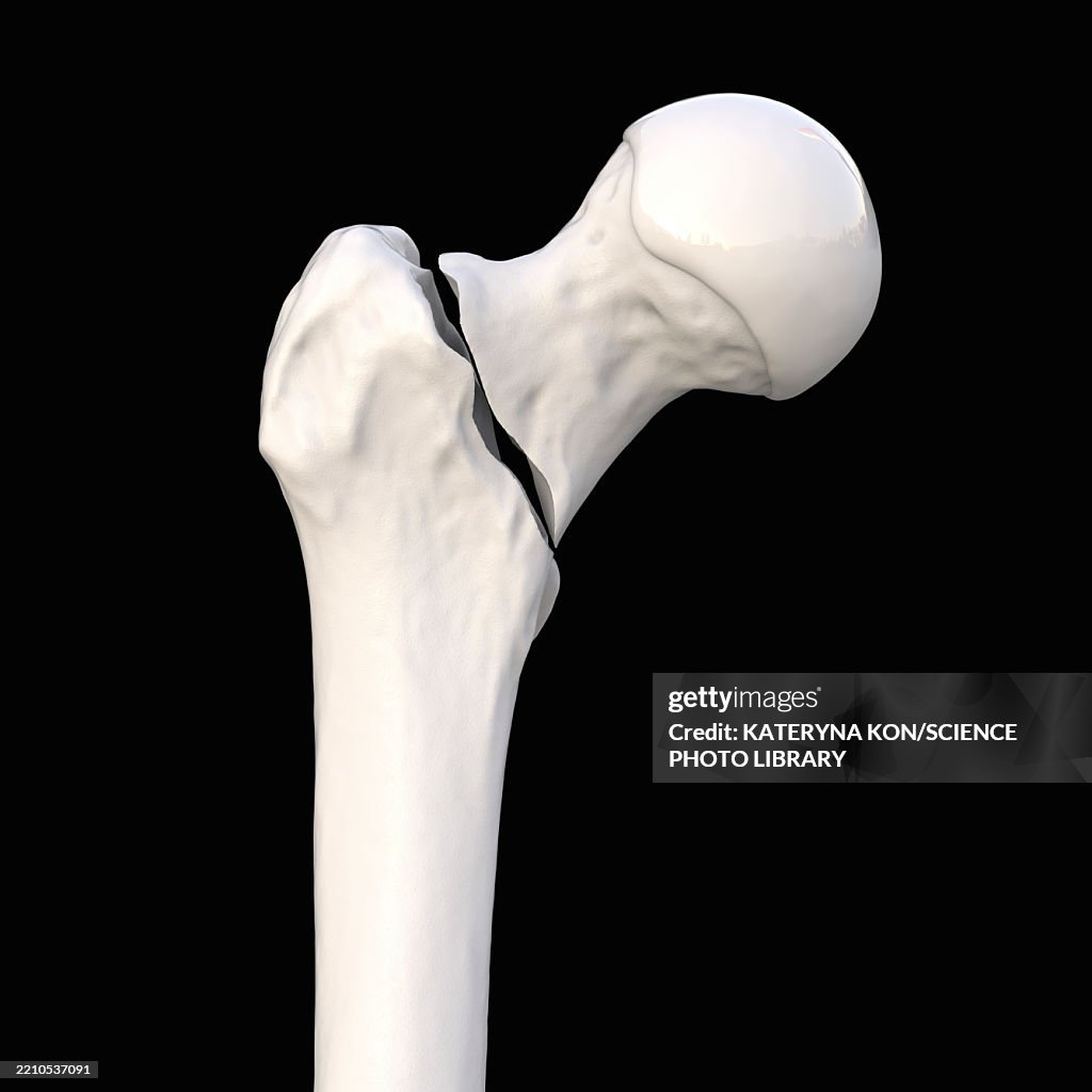 Basicervical Basicervical Femur Fracture Illustration High-Res Vector Graphic ...