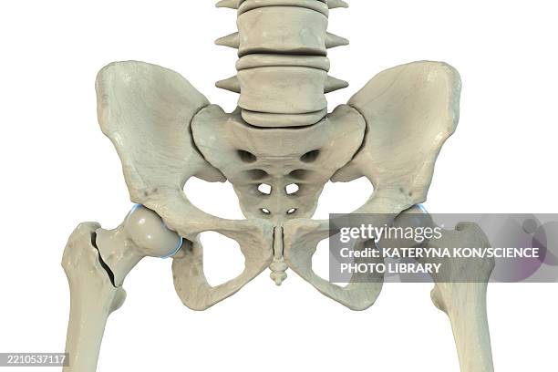 Basicervical Basicervical Femur Fracture Illustration High-Res Vector Graphic ...