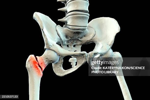 Basicervical Basicervical Femur Fracture Illustration High-Res Vector Graphic ...