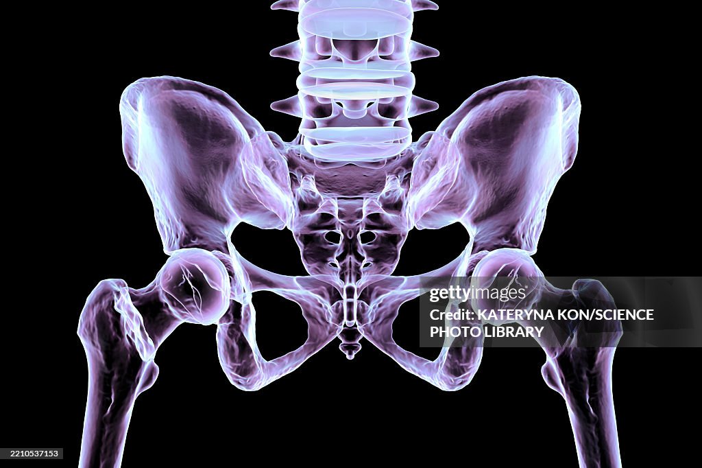 Basicervical Basicervical Femur Fracture Illustration High-Res Vector Graphic ...