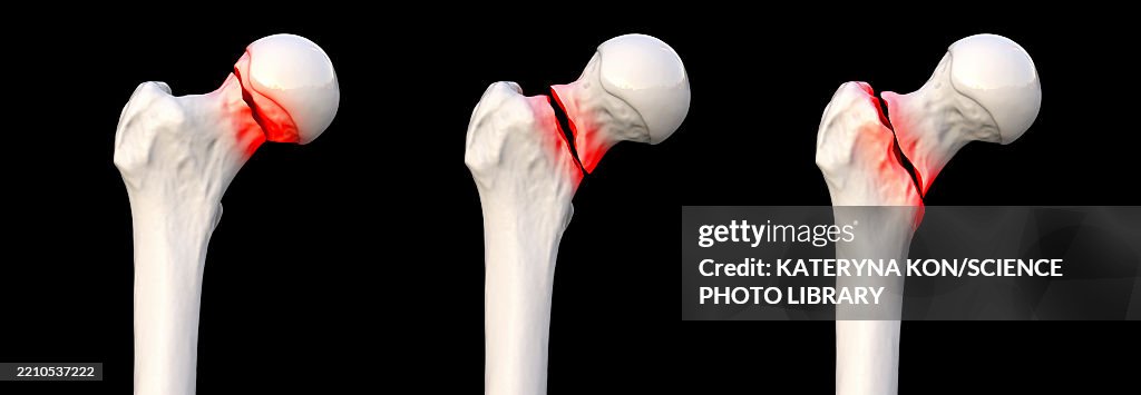 Basicervical Femur Neck Fracture Types Illustration High-Res Vector Graphic - Getty ...