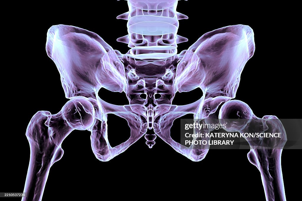 Hip dysplasia, illustration