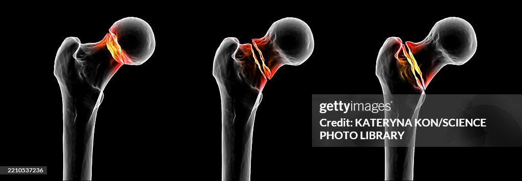 Basicervical Femur Neck Fracture Types Illustration High-Res Vector Graphic - Getty ...
