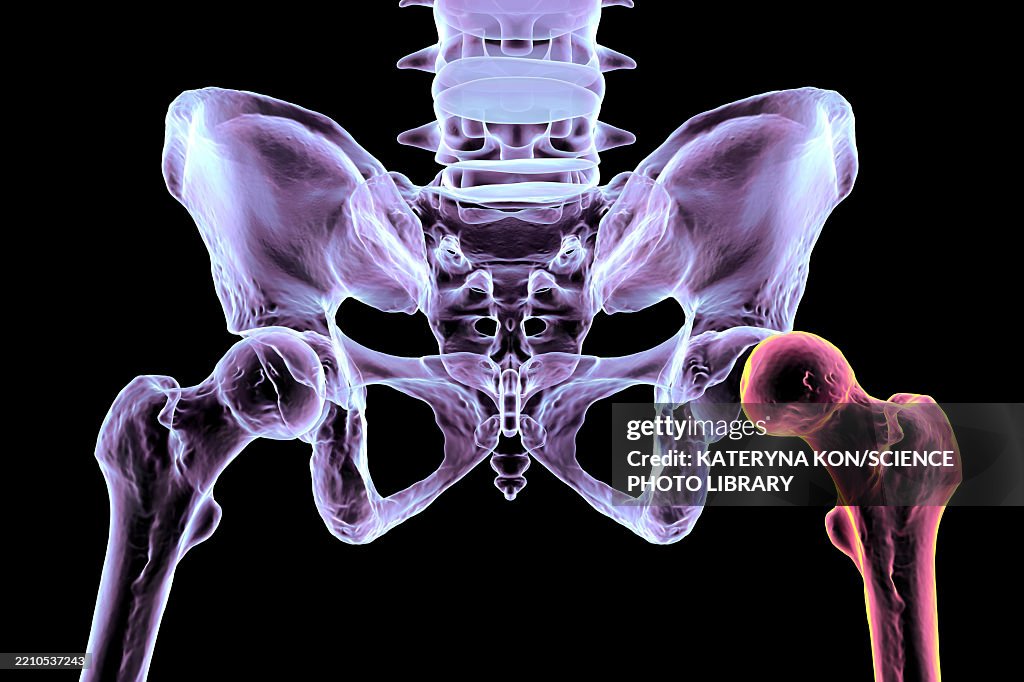 Hip dysplasia, illustration
