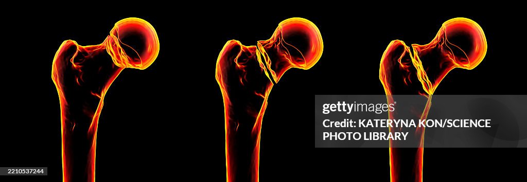 Basicervical Femur Neck Fracture Types Illustration High-Res Vector Graphic - Getty ...