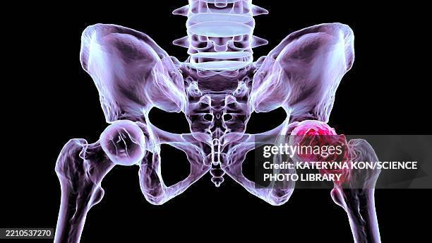illustrations, cliparts, dessins animés et icônes de hip osteoarthritis, illustration - col du fémur