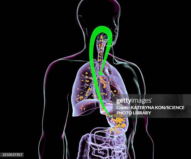 aspiration pneumonia, illustration - dysphagia stock illustrations