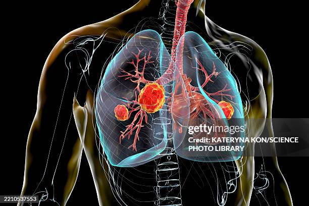 illustrations, cliparts, dessins animés et icônes de lung mucormycosis, illustration - aspergillose