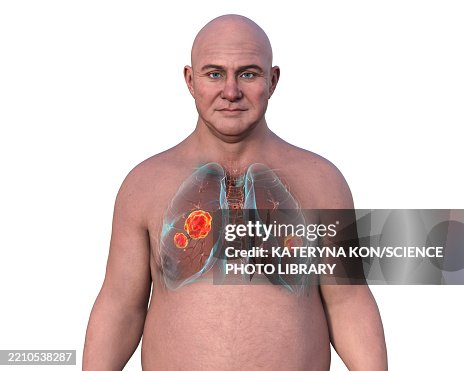 Lung mucormycosis, illustration Lung mucormycosis, illustration
