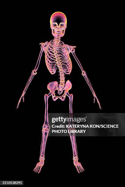 human skeleton with scoliosis, illustration - scoliosis stock illustrations