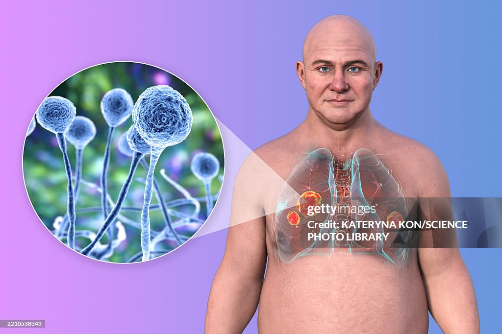 Lung mucormycosis, illustration