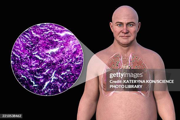 lung silicosis and light micrograph, illustration - light micrograph stock illustrations