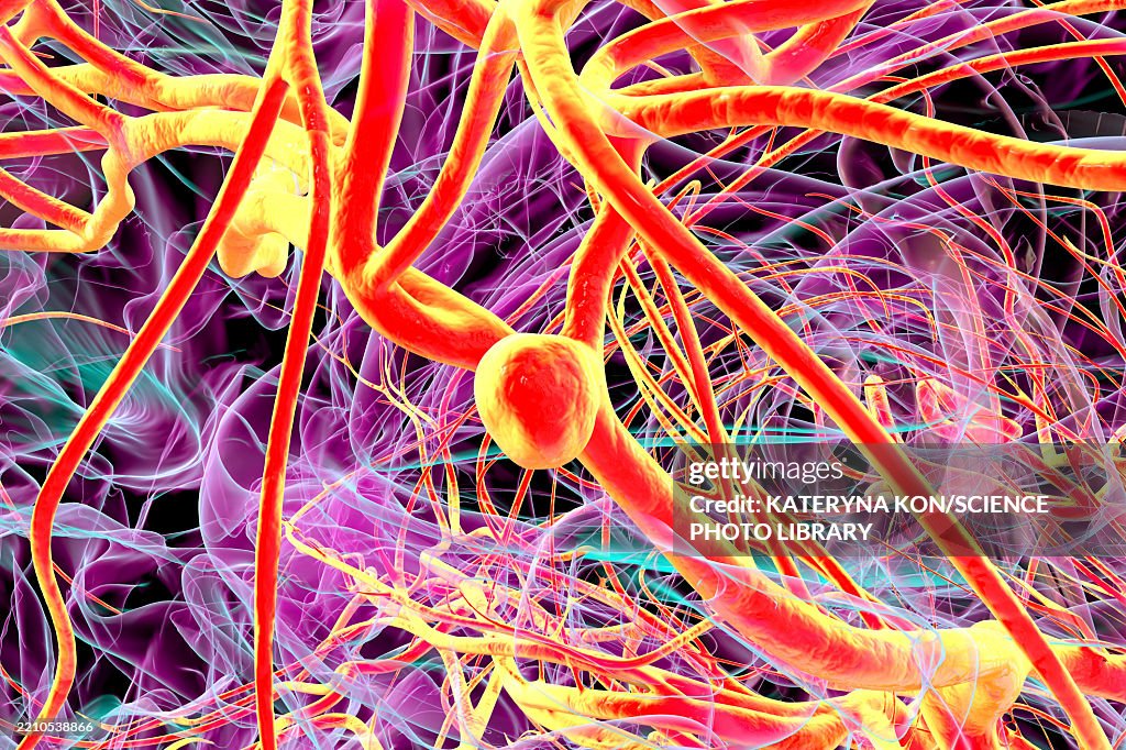 Saccular Brain Aneurysm Illustration High-Res Vector Graphic - Getty Images