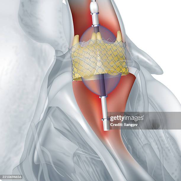 heart valve replacement - stent replacement stock illustrations