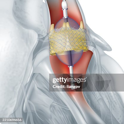 Heart valve replacement Heart valve replacement