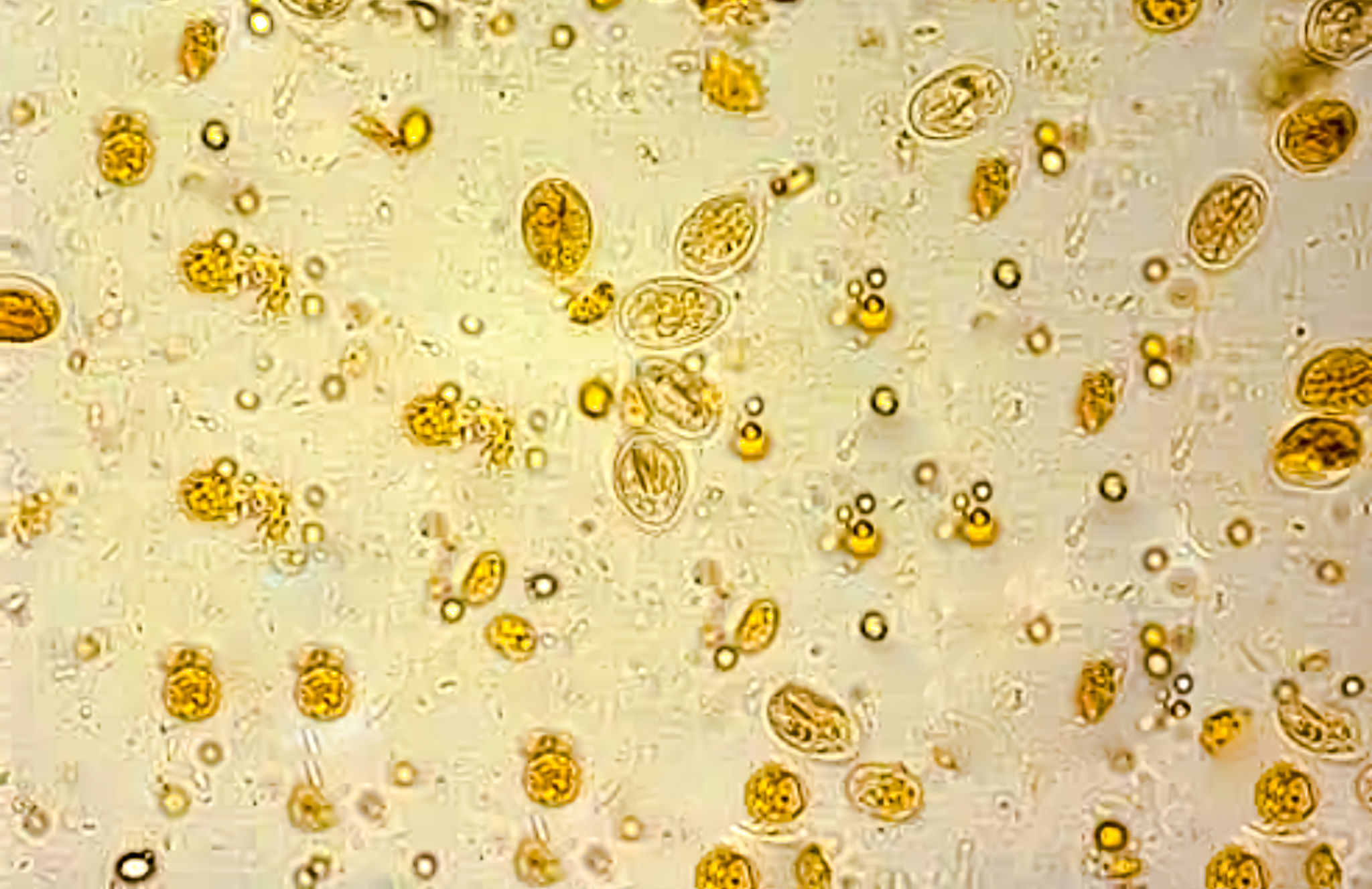 Giardia lamblia cyst analysed by microscope. causing diarrhea Giardia lamblia cyst analysed by microscope. causing diarrhea