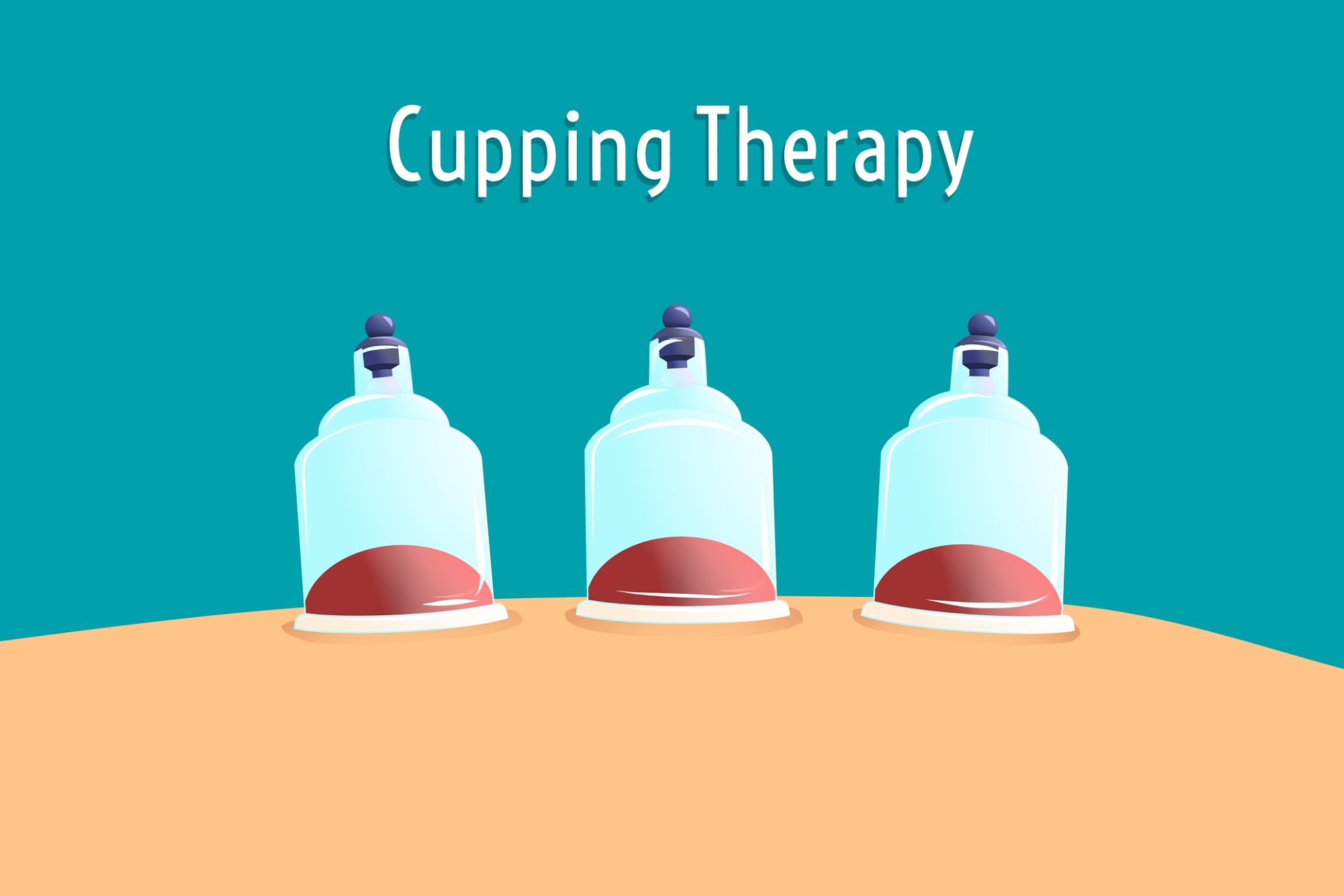 Illustration of traditional Chinese medicine therapy. cupping therapy, a treatment used to relieve pain and other health benefits. Selective focus. Illustration of traditional Chinese medicine therapy. cupping therapy, a treatment used to relieve pain and other health benefits. Selective focus.