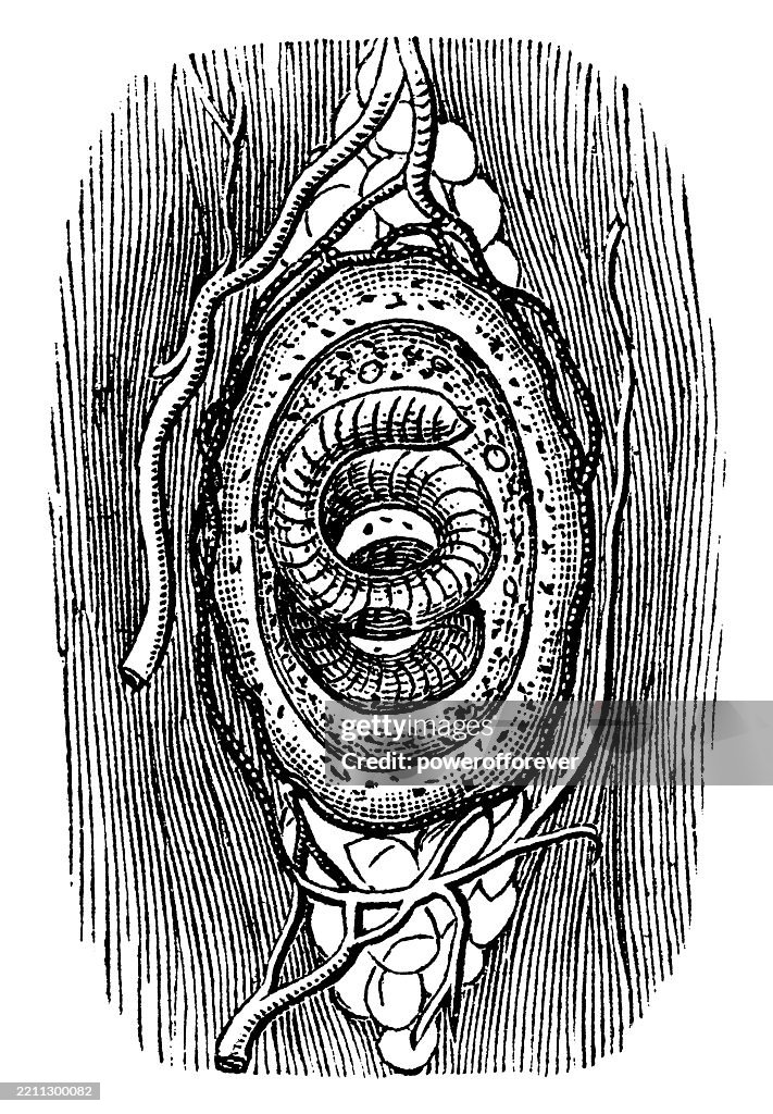 Triangular Roundworm Trichinella Spiralis Roundworm Larvae Coiled Up In A Cyst 19th Century ...