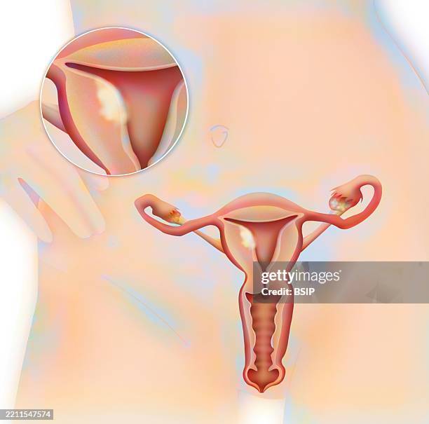 cancer endometrium, drawing - endometrial cancer stock illustrations