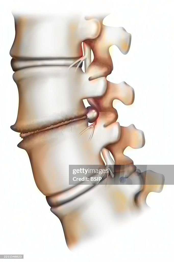 Spondylarthrosis drawing