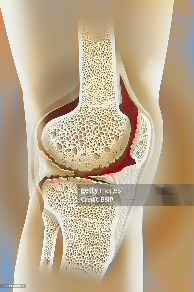 Osteoarthritis Knee Drawing