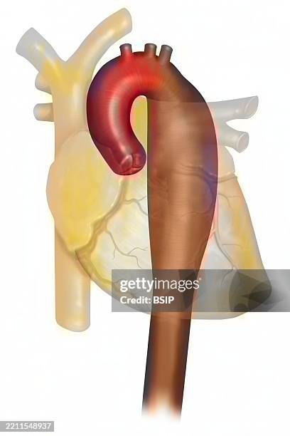 ilustrações de stock, clip art, desenhos animados e ícones de thoracic aortic aneurysm - aorta