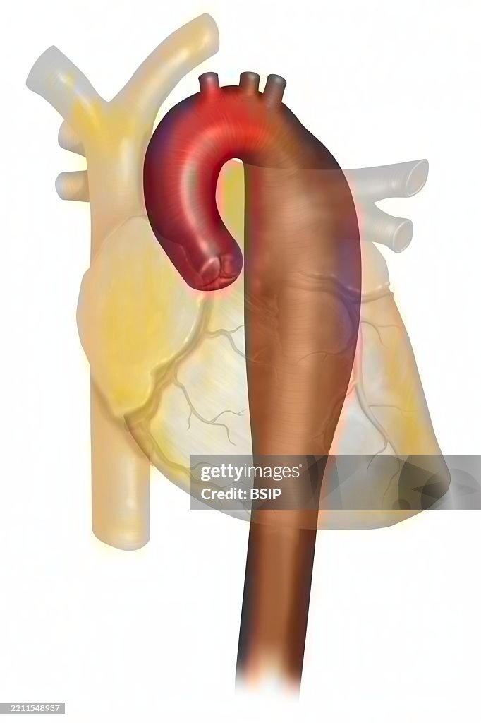 Thoracic aortic aneurysm