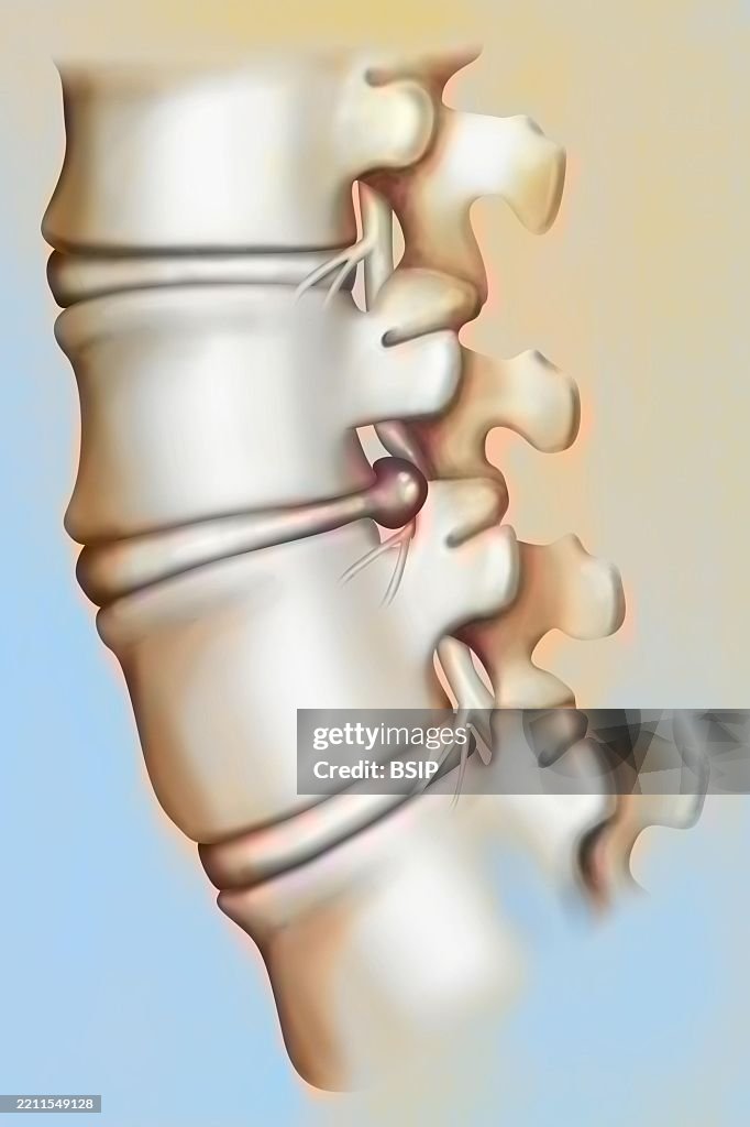 Herniated disc
