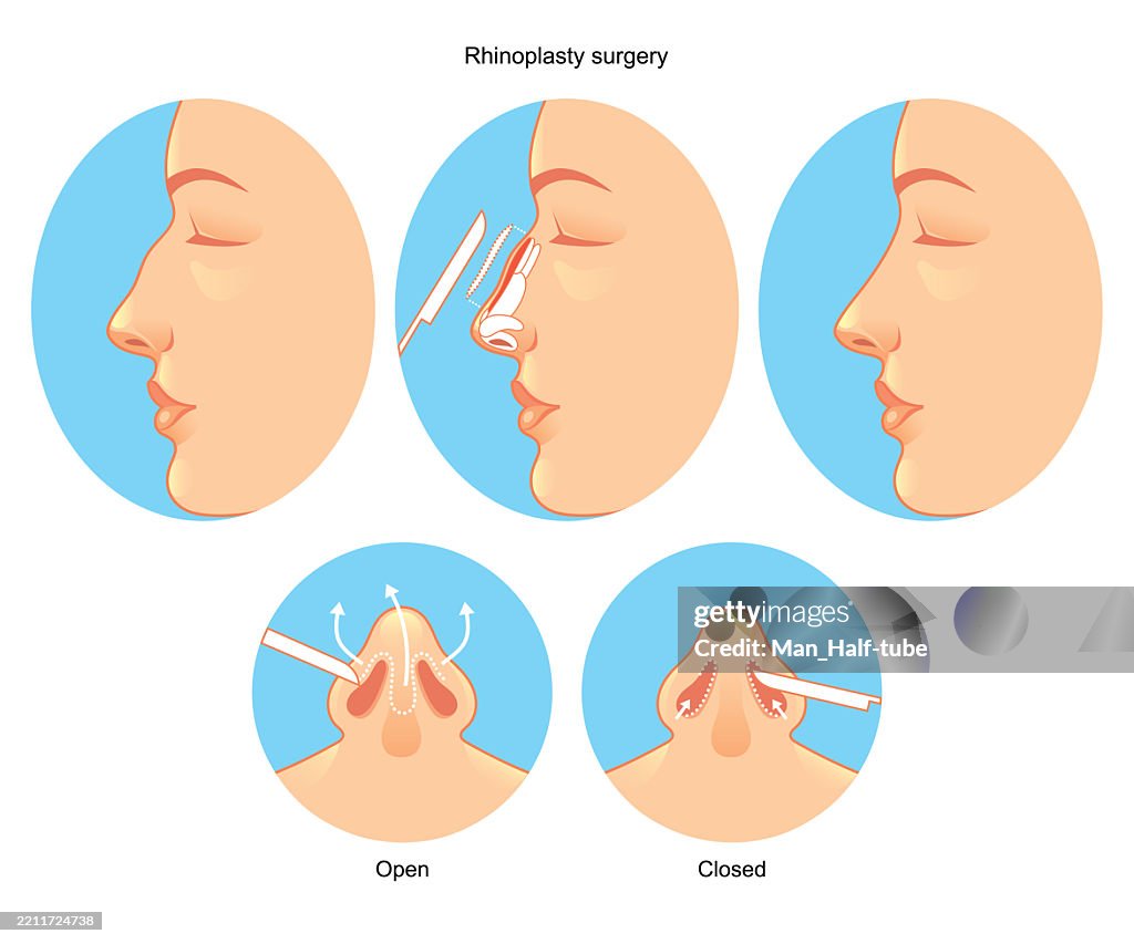 Rhinoplasty