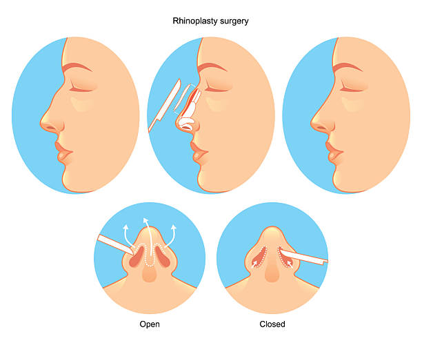 Complete Transfixation Rhinoplasty 46 Rhinoplasty High Res Illustrations - Getty Images