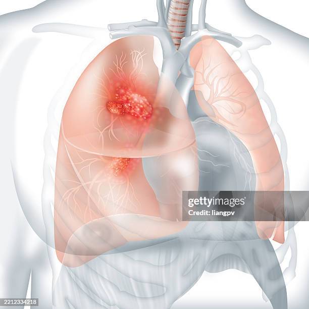lung cancer - lungenkrebs stock-grafiken, -clipart, -cartoons und -symbole