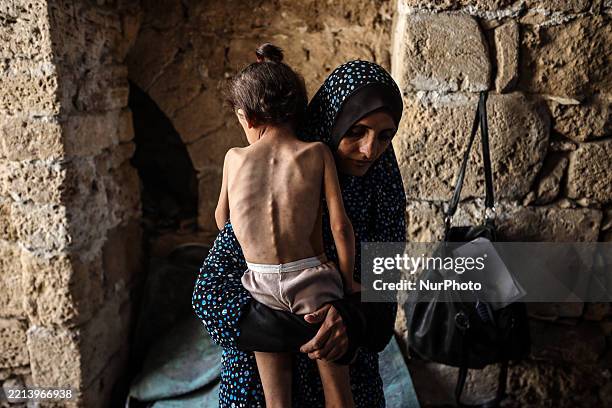 Islam Hajjaj holds her 6-year-old daughter Najwa, who suffers from malnutrition, at a shelter in central Gaza City, on May 11, 2025. Amnesty...