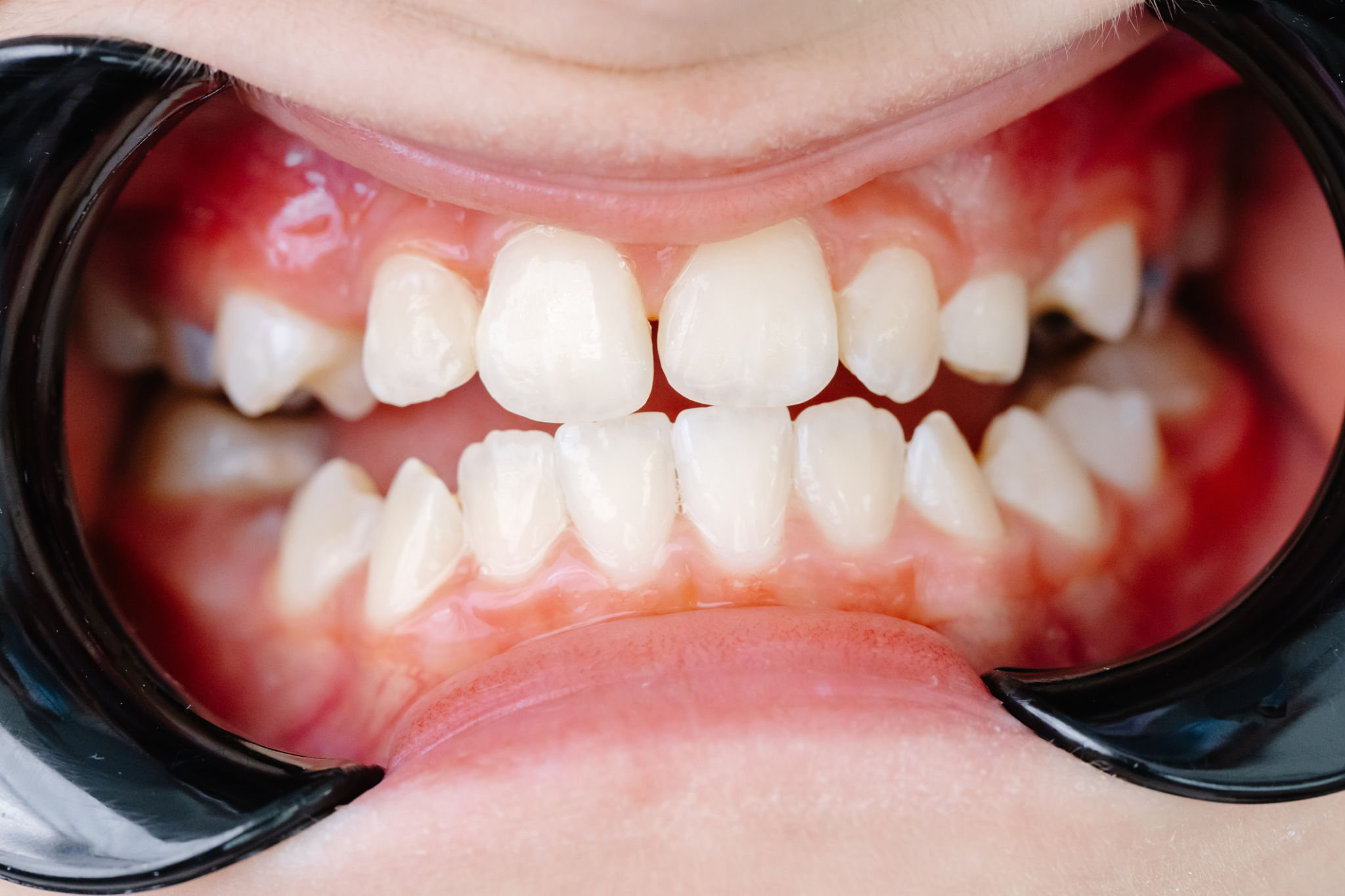 teeth alignment