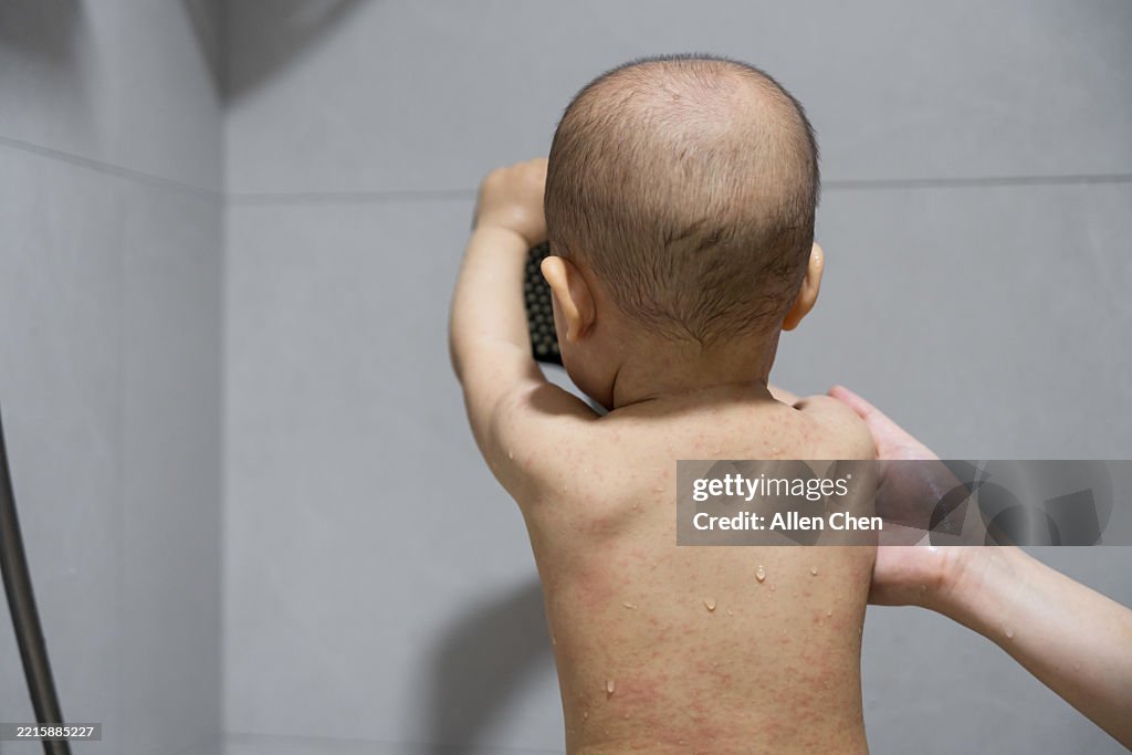 Childhood rash; After a baby has a fever; baby shower