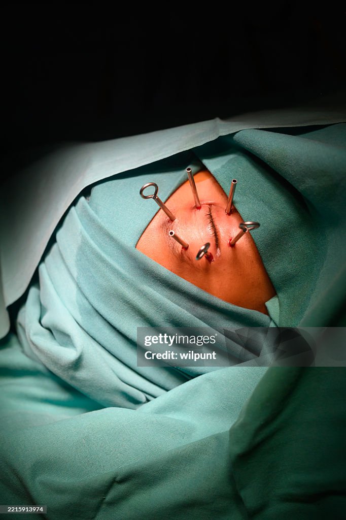 Young patient Eye brachytherapy surgical procedure for cancer treatment in an oncology hospital