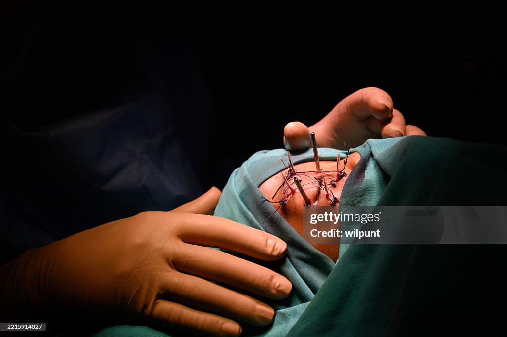 Eye brachytherapy procedure being performed in a medical oncology surgery setting