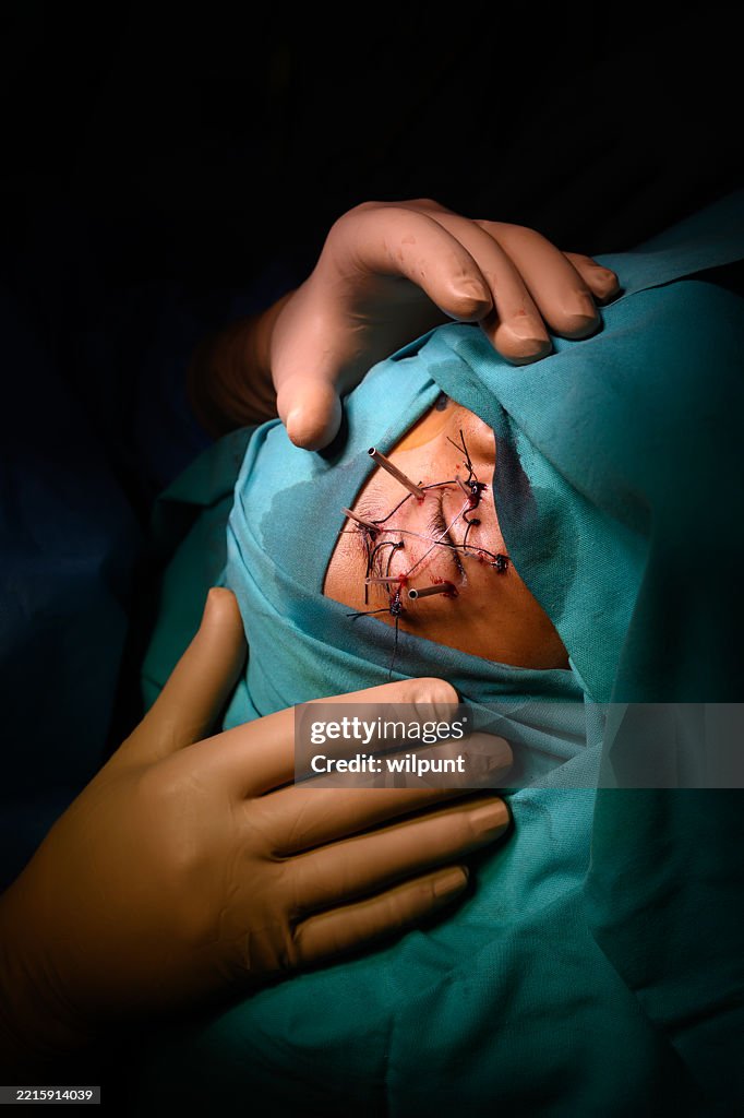 Medical Ophthalmic surgery or Ocular surgery oncology procedure on young patient in specialised surgical hospital