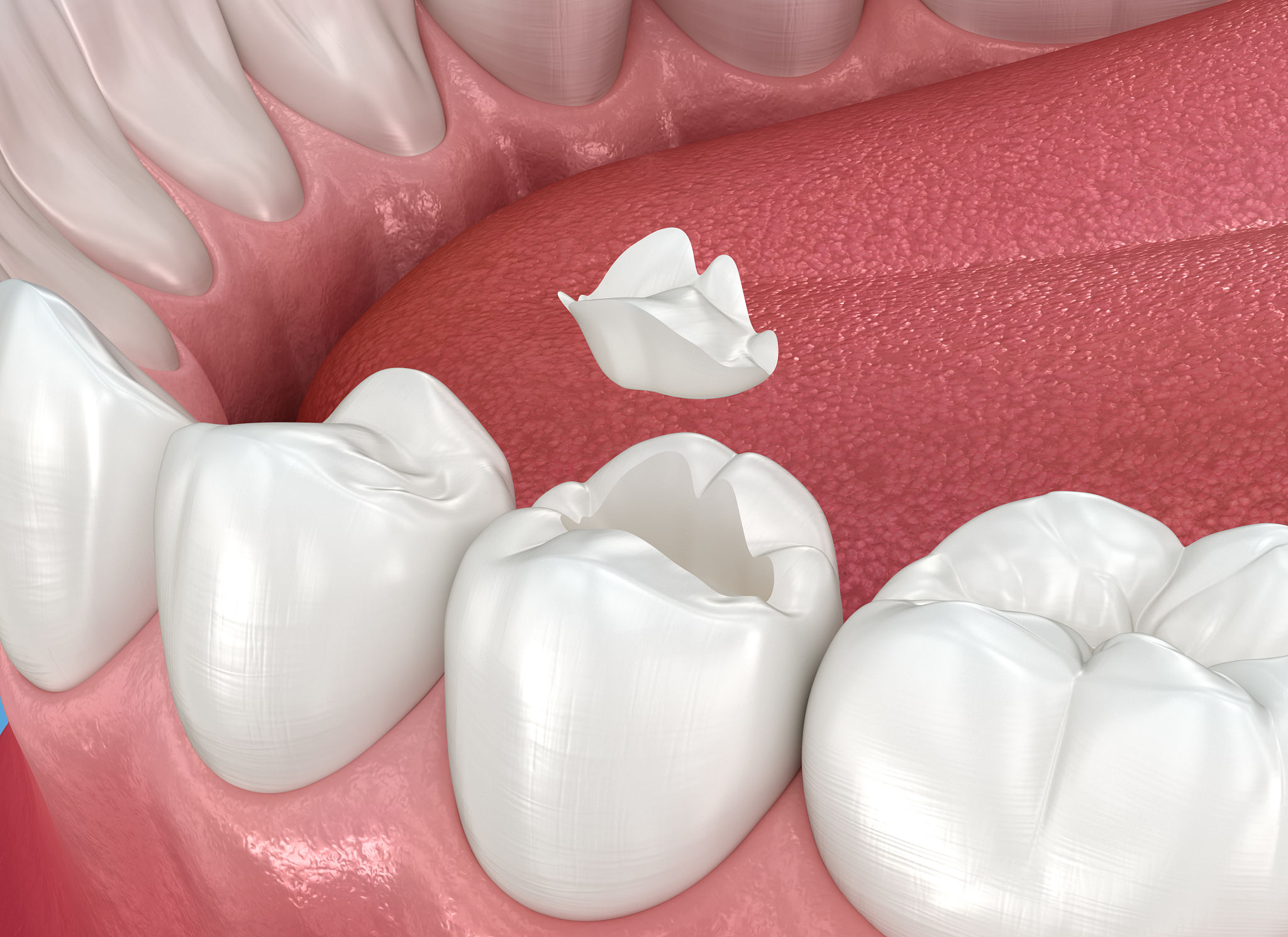 dental sealants