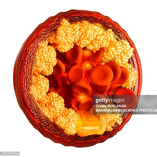 stockillustraties, clipart, cartoons en iconen met cholesterol plaques in blood vessel, illustration - menselijke slagader