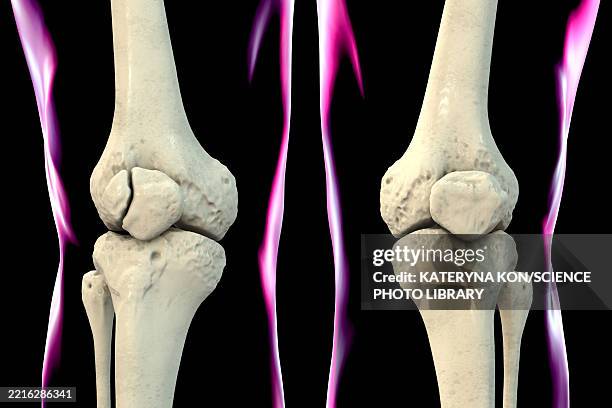 illustrations, cliparts, dessins animés et icônes de bipartite patella, illustration - rotule