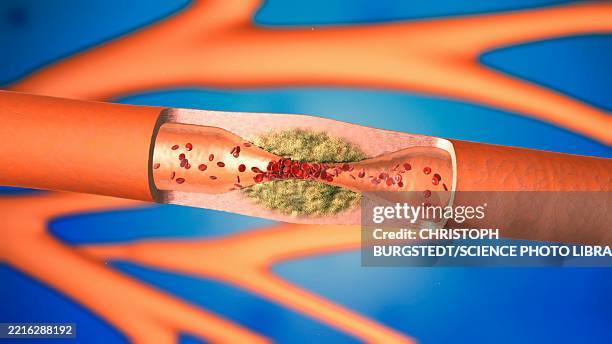 narrowed artery, illustration - atherosklerose stock-grafiken, -clipart, -cartoons und -symbole