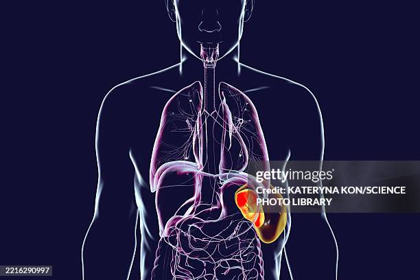 splenomegaly, illustration - malaria stock illustrations