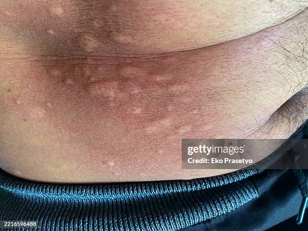 Stomach Skin Allergy Affected By Caterpillars High Res Stock Photo stomach-skin-allergy-affected-by-caterpillars-high-res-stock-photo