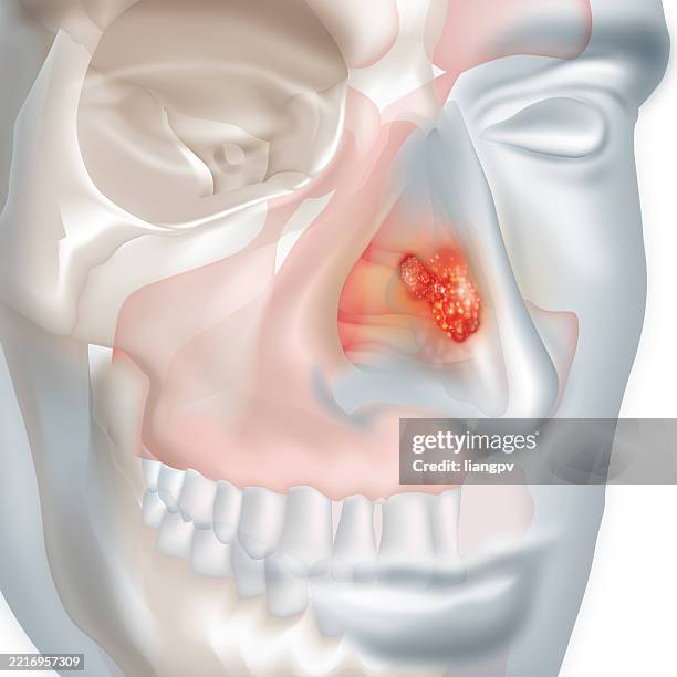 illustrazioni stock, clip art, cartoni animati e icone di tendenza di cancro al naso - naso umano