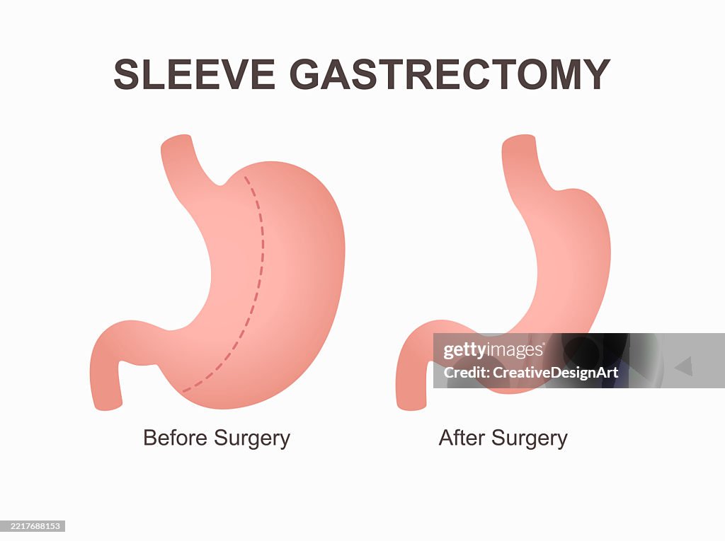 Gastrectomia a manica verticale per la perdita di peso. Stomaco prima e dopo l'intervento chirurgico. Problema di sovrappeso