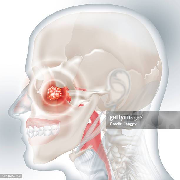 illustrazioni stock, clip art, cartoni animati e icone di tendenza di cancro al naso - naso umano