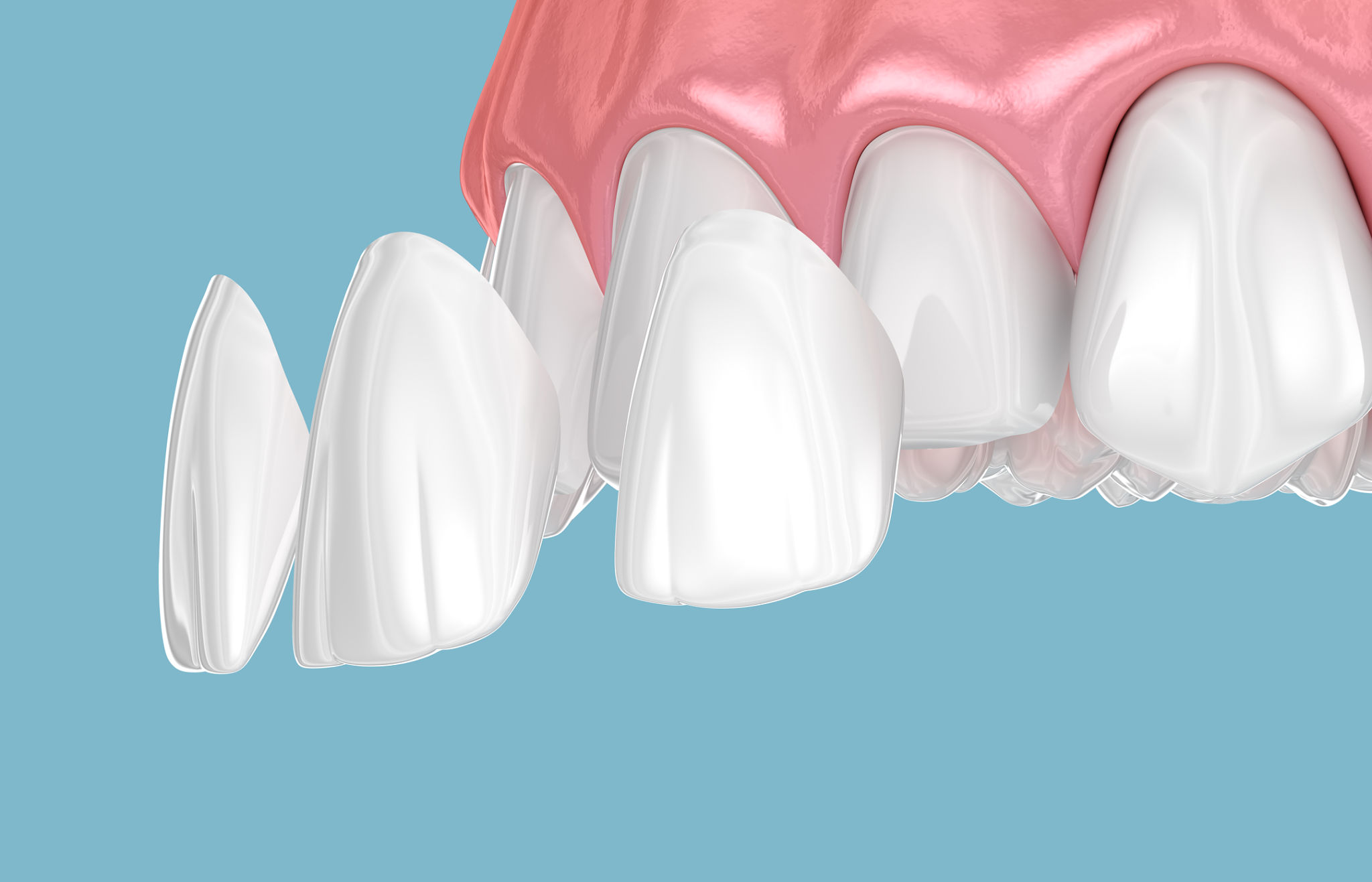 Dental veneer placement over frontal teeth. 3D illustration Dental veneer placement over frontal teeth. 3D illustration