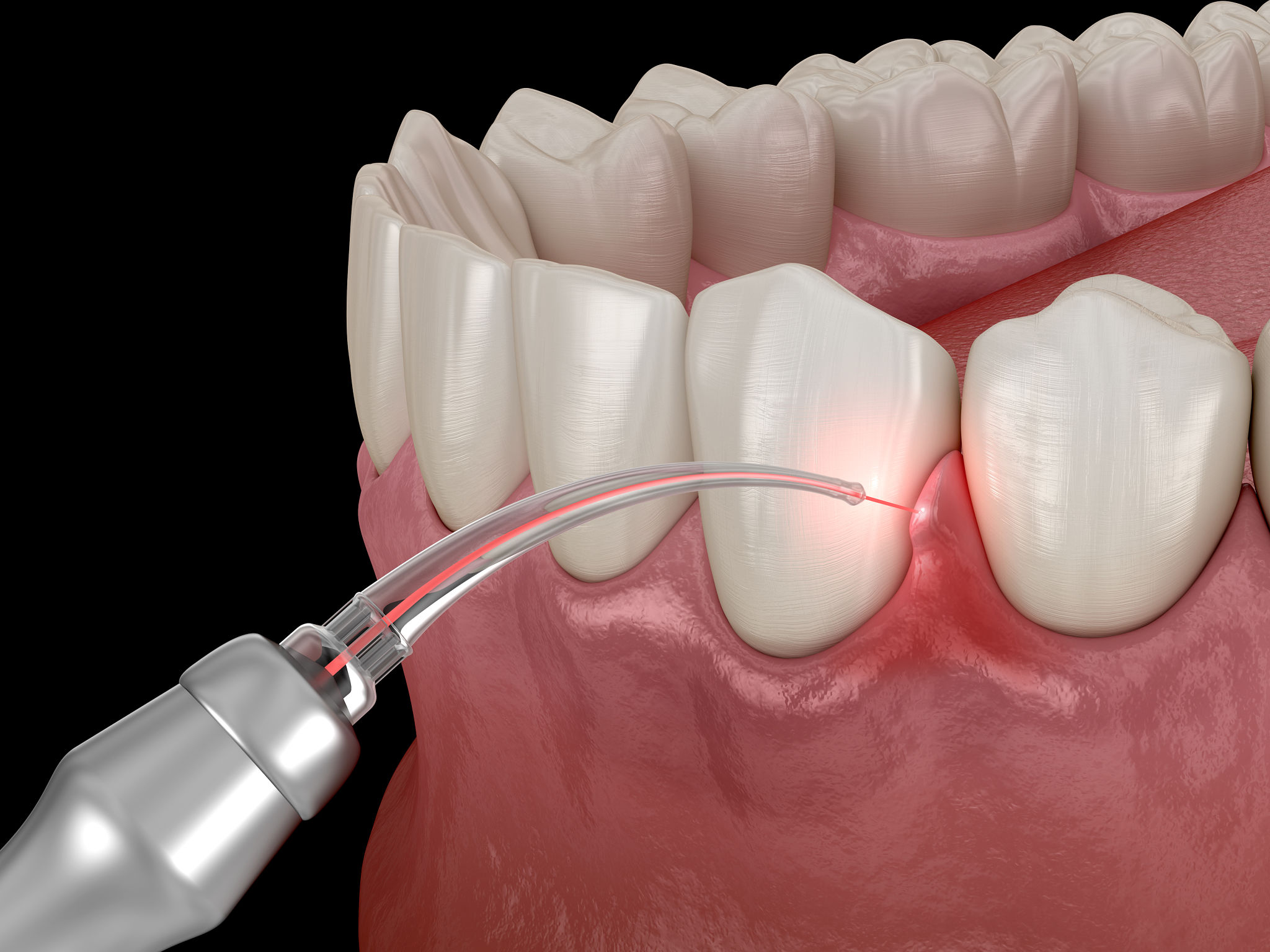 laser dentistry
