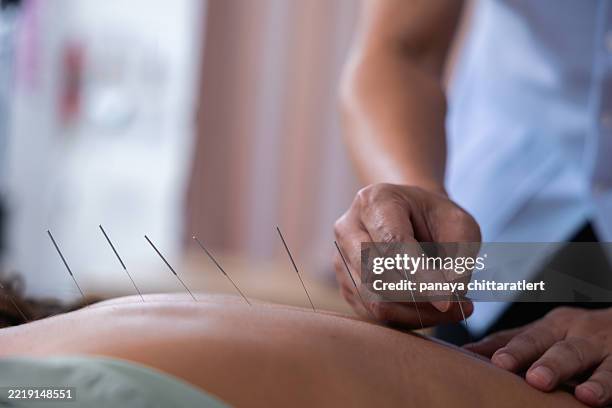 performing acupuncture on a patients back.a close-up of a patient receiving acupuncture an treatment on the back.acupuncture back treatment. - acupuncture needle stock pictures, royalty-free photos & images