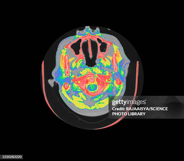 jefferson fracture, ct scan - vertebral fracture stock pictures, royalty-free photos & images